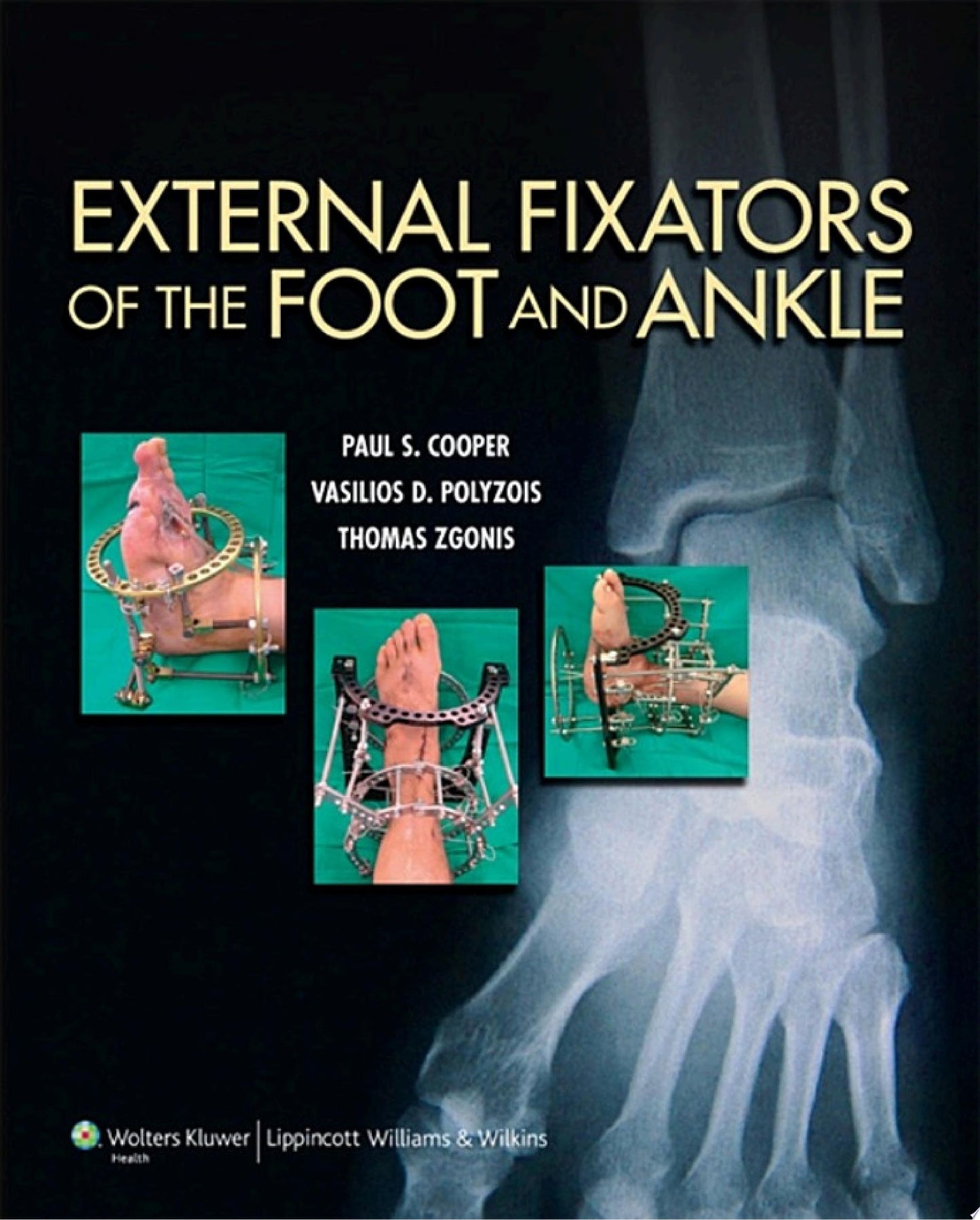 External Fixators of the Foot and Ankle (ORIGINAL PDF from Publisher)