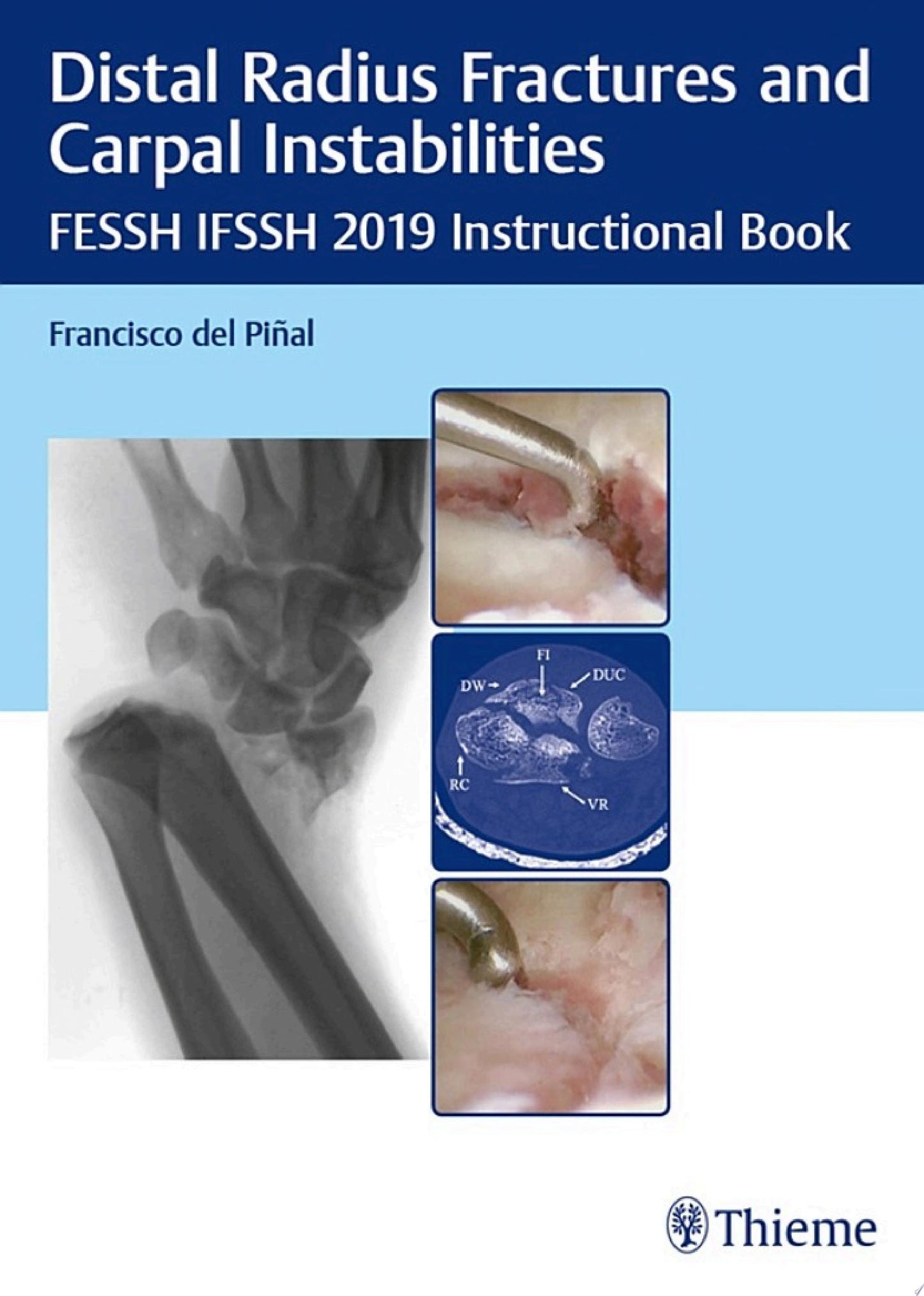 Distal Radius Fractures and Carpal Instabilities: FESSH IFSSH 2019 Instructional Book (PDF)