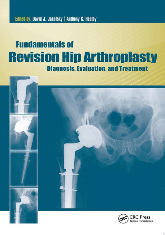 Fundamentals of Revision Hip Arthroplasty: Diagnosis, Evaluation, and Treatment