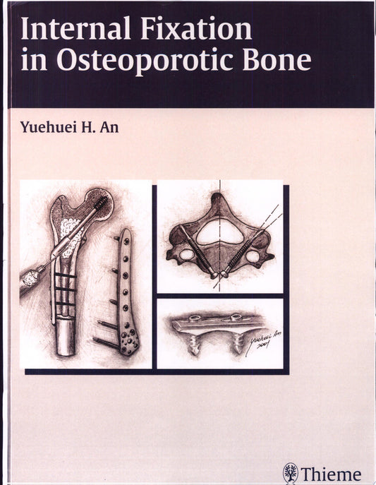 Internal Fixation in Osteoporotic Bone