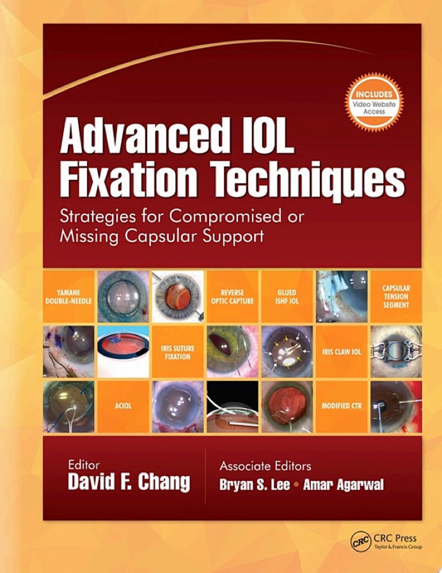 Advanced IOL Fixation Techniques: Strategies for Compromised or Missing Capsular Support